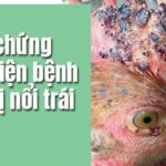 Hướng Dẫn Cách Trị Gà Bị Nổi Trái Bằng Dược Liệu Dân Gian